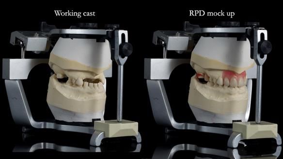 Newsletter 81 - Pam’s Story — how a partial denture changed her life (+ live walkthrough this Thursday)