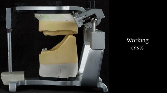 Working casts - class III skeletal relationship