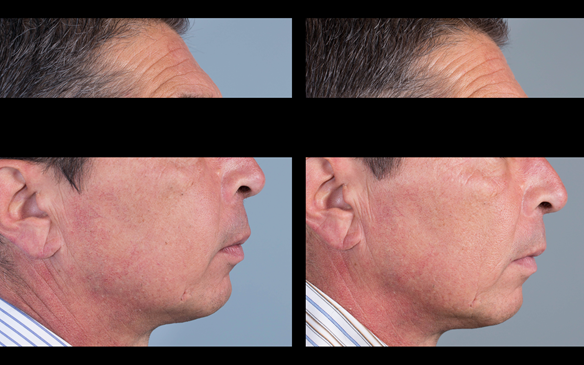 Figure 60 5 months post fitting of Mk 1 immediate dentures