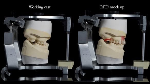 Newsletter 81 - Pam’s Story — how a partial denture changed her life (+ live walkthrough this Thursday)