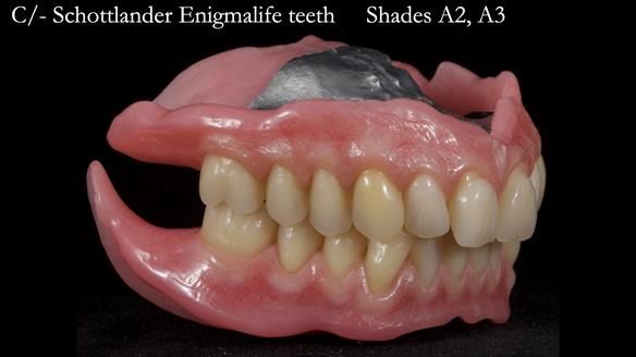 Newsletter 57 showcases the making and fitting process of implant-supported complete dentures for Alisdair