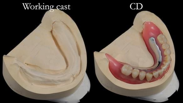 Finlay's Newsletter 62 provision of extractions and metal based complete dentures for Rafique