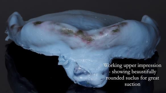 Newsletter 83: Sheila’s Complete Denture Success