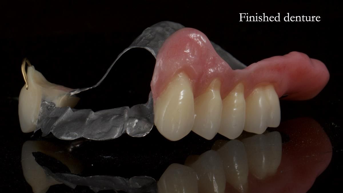 Newsletter 89 – Simon: A Challenging Kennedy Class II Division 1 Upper CoCr Partial Denture with a High Smile Line