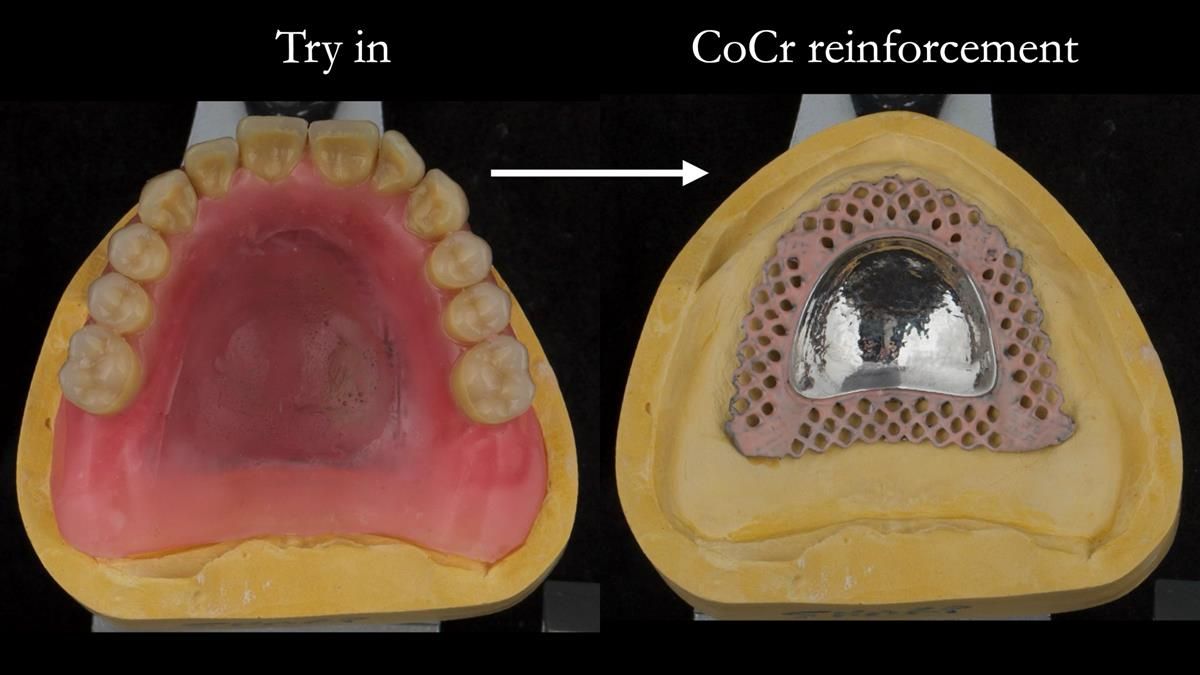 Newsletter 87 – Father Peter: A Partial Denture that needed Minor Miracle
