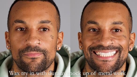 Upper metal base partial denture/occlusal stabilisation splint/obturator - full protocol