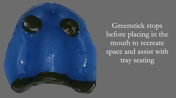 Newsletter 53 showing the making and fitting of ultra life-like dentures for Valena