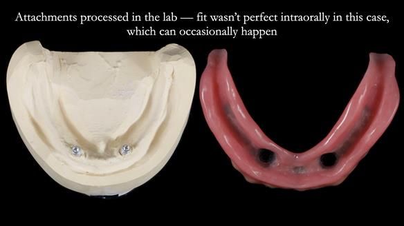 Newsletter 78: What do Clark Gable and a Locator® overdenture have in common?