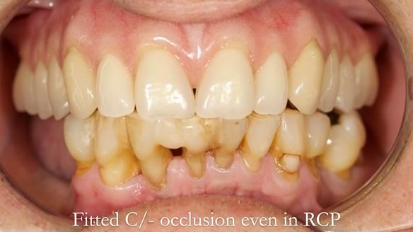 Newsletter 54 case presentation upper complete denture and lower Scandinavian designed hygienic partial denture for David