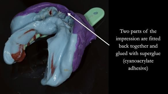 Finlay's Case Study Newsletter 40 - Immediate Mk 1 RPD to Definitive Mk 2 RPD - full protocol