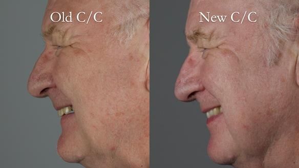 Newsletter 57 showcases the making and fitting process of implant-supported complete dentures for Alisdair