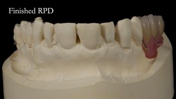 Finlay's Newsletter 64 case study - provision of a Kennedy class 2 metal based Scandinavian RPD for Ian