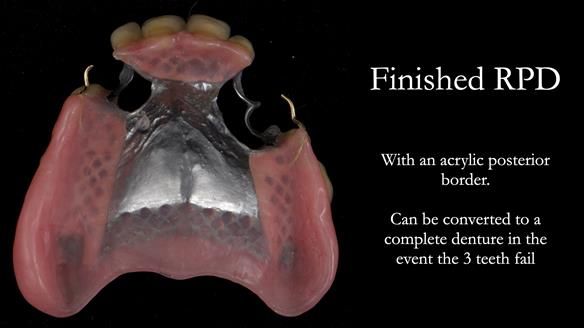 Finlay's Newsletter 59 Ultra hard partial dentures made for Gill
