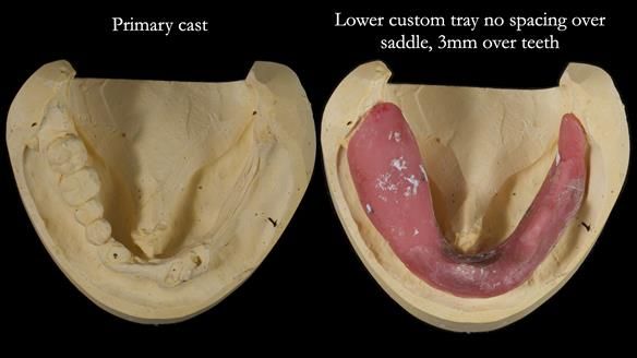 Newsletter 82 Mary - A complete upper and a one-tooth gasket denture