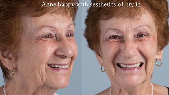 Newsletter 51 Managing Anne’s failing dentition with distal extension base RPD/Splint FULL PROTOCOL