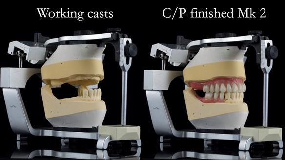 Newsletter 52 Managing Jo’s failing dentition with extractions and Mk 1/Mk 2 complete upper dentures and lower partial dentures FULL PROTOCOL