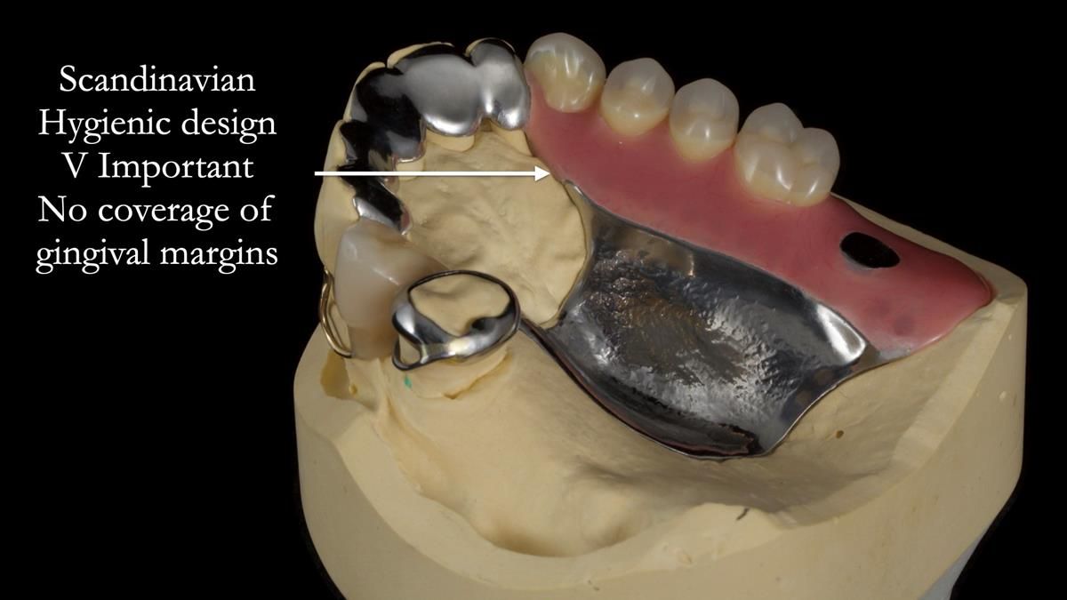 Newsletter 89 – Simon: A Challenging Kennedy Class II Division 1 Upper CoCr Partial Denture with a High Smile Line