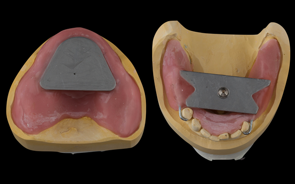 Figure 83 Visit 3 for Mk 2 fabrication. Inter-maxillary registration with central bearing apparatus made on light cured tray maker for accurate CR recording