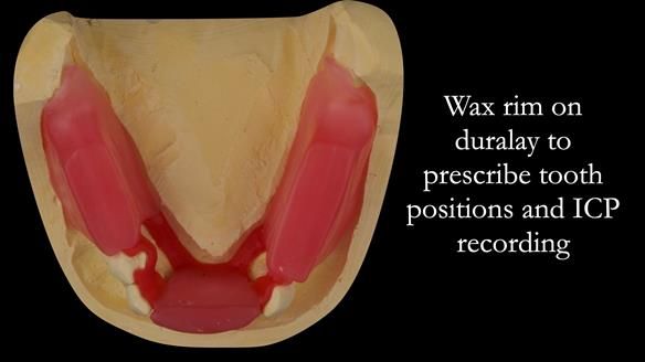 Finlay's Case Study Newsletter 40 - Immediate Mk 1 RPD to Definitive Mk 2 RPD - full protocol