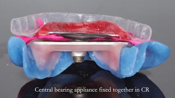 Newsletter 82 Mary - A complete upper and a one-tooth gasket denture