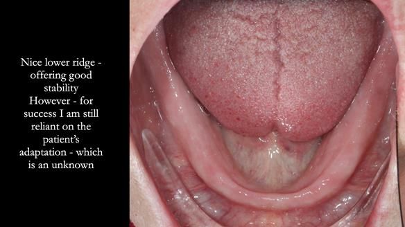 Newsletter 70 Complete Denture Treatment for Kate: A Case Study on Natural-Looking Dentures and Implant-Supported Overdentures
