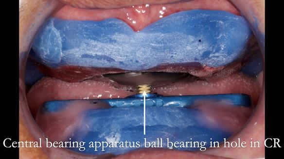 Finlay's Newsletter 62 provision of extractions and metal based complete dentures for Rafique