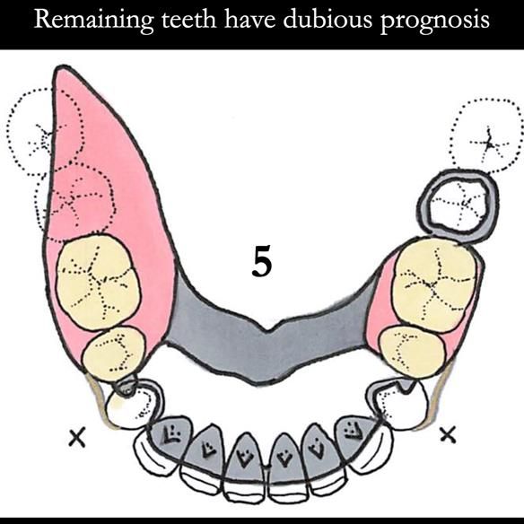 Universal Scandinavian partial denture designs