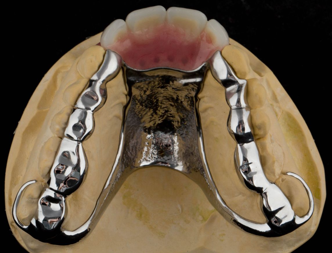Provision of a maxillary cobalt chromium based partial denture/protective occlusal splint in a heavily restored dentition