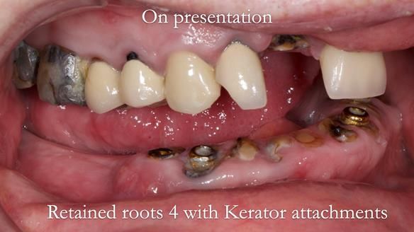 Newsletter 44 - extreme removable prosthodontics – engineering a super-strong and ultra-thin over denture
