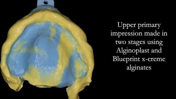 Newsletter 52 Managing Jo’s failing dentition with extractions and Mk 1/Mk 2 complete upper dentures and lower partial dentures FULL PROTOCOL