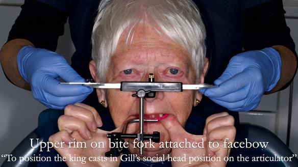 Finlay's Newsletter 59 Ultra hard partial dentures made for Gill