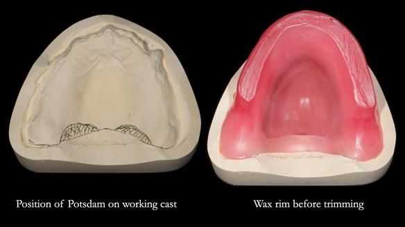 Finlay's Newsletter 62 provision of extractions and metal based complete dentures for Rafique