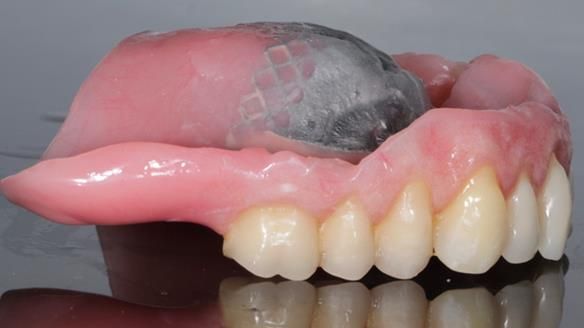 Finlay's Newsletter 62 provision of extractions and metal based complete dentures for Rafique