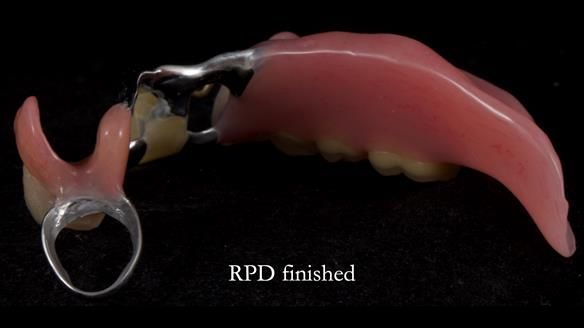 Newsletter 55 Provision of metal based partial dentures for Zephyrine with a repaired cleft lip and palate