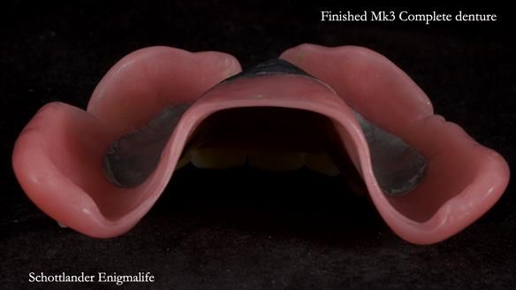 Newsletter 77: Jeremy’s case – immediate complete upper denture