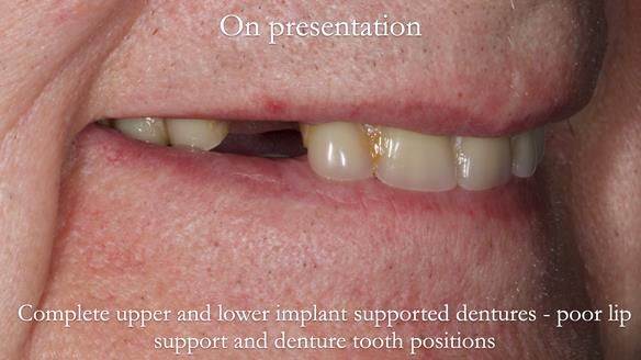 Newsletter 57 showcases the making and fitting process of implant-supported complete dentures for Alisdair