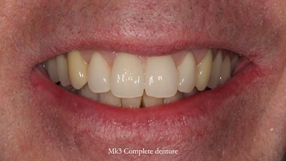 Newsletter 77: Jeremy’s case – immediate complete upper denture