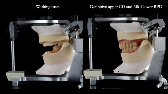 Newsletter 82 Mary - A complete upper and a one-tooth gasket denture