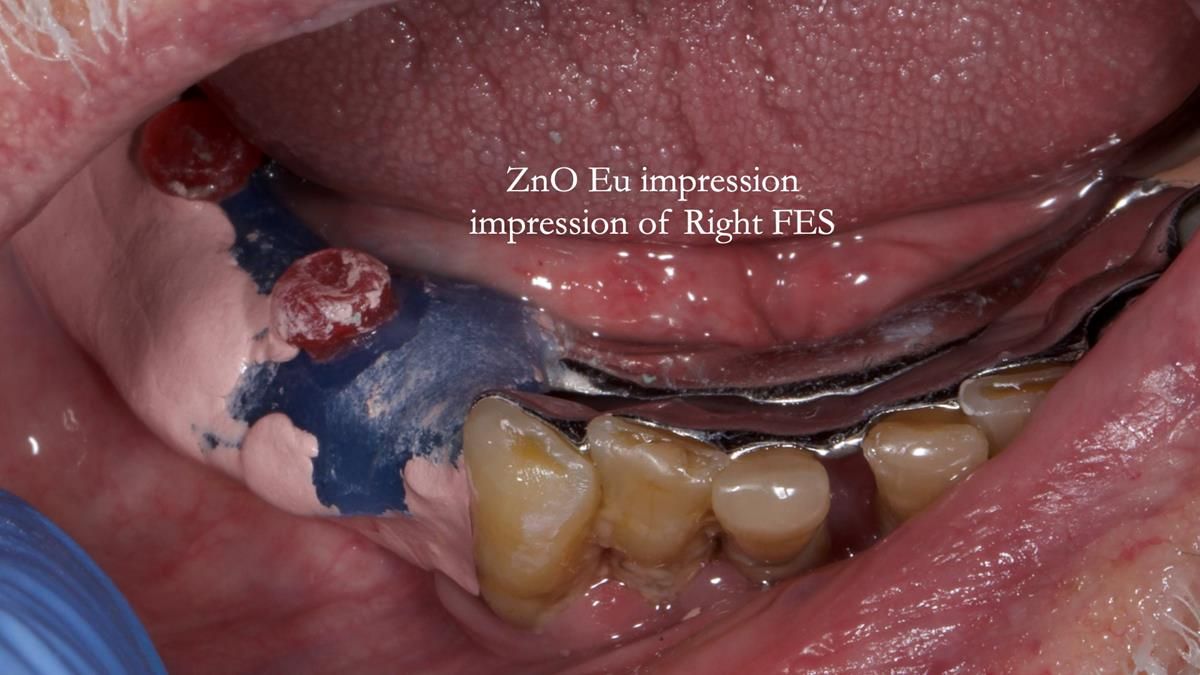 Newsletter 87 – Father Peter: A Partial Denture that needed Minor Miracle