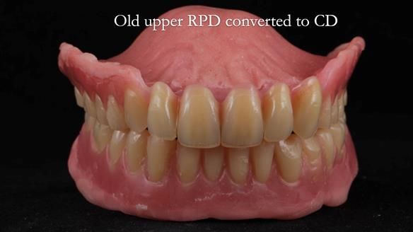 Finlay's Newsletter 62 provision of extractions and metal based complete dentures for Rafique