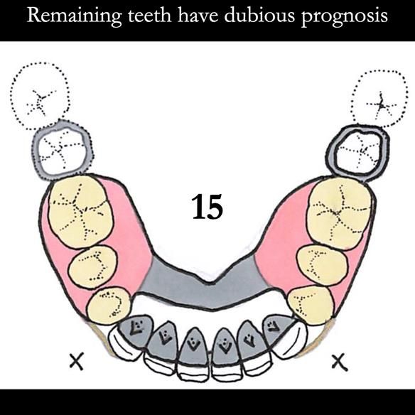 Universal Scandinavian partial denture designs