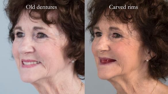 Newsletter 75: Marion’s case - Step-by-step complete denture workflow