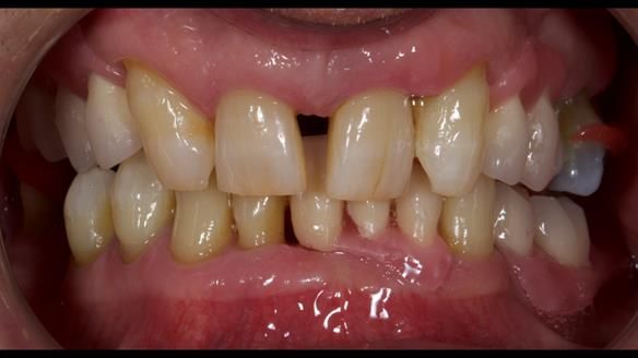 Newsletter 86 Peter the Architect — precision removable partial dentures case study
