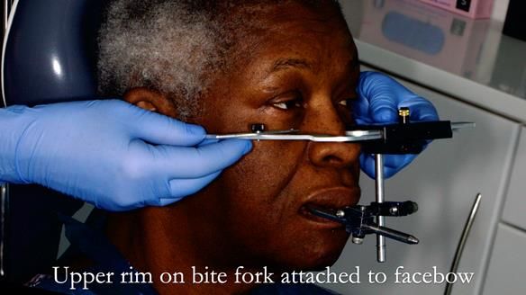 Newsletter 53 showing the making and fitting of ultra life-like dentures for Valena