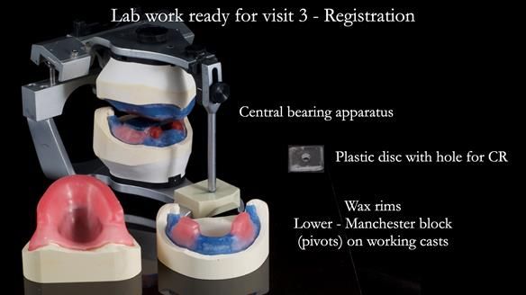 Newsletter 78: What do Clark Gable and a Locator® overdenture have in common?