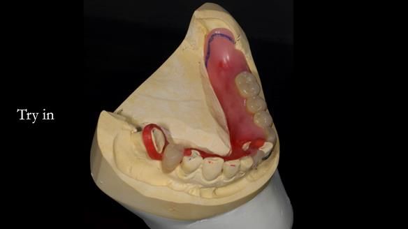 Newsletter 55 Provision of metal based partial dentures for Zephyrine with a repaired cleft lip and palate