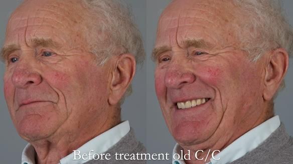 Complete denture Class II div 2 deep overbite Newsletter 39