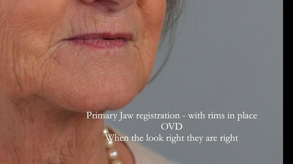 Rims trimmed to occlusal vertical dimension. When the patient looks right they are right.