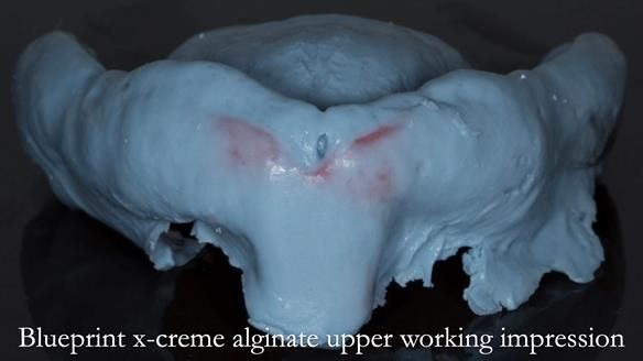 Newsletter 75: Marion’s case - Step-by-step complete denture workflow