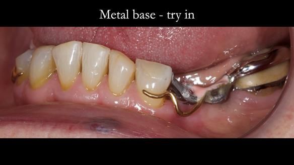 Eileen's transformation with upper and lower RPDs of Scandinavian hygienic design FULL PROTOCOL